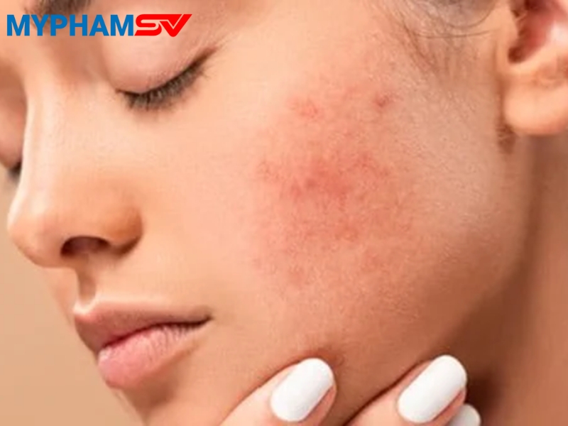 Cách xử lý khi bị dị ứng mỹ phẩm nhanh chóng và an toàn