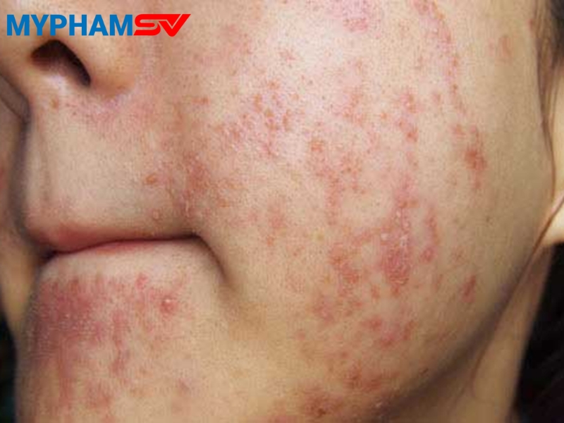 Cách xử lý khi bị dị ứng mỹ phẩm nhanh chóng và an toàn