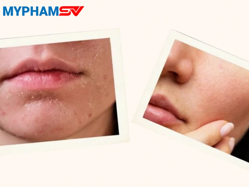 Cách xử lý khi bị dị ứng mỹ phẩm nhanh chóng và an toàn