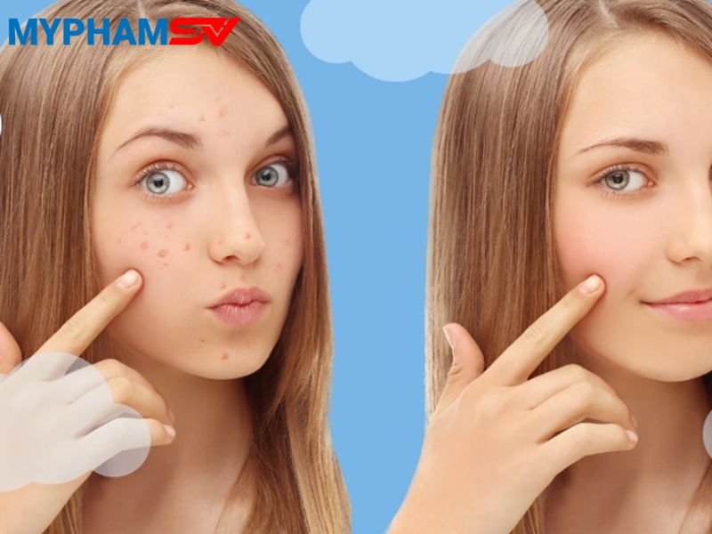Cách chọn kem chống nắng cho da mụn