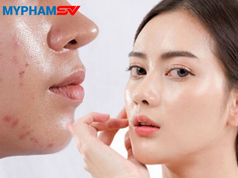 Cách chọn kem chống nắng cho da mụn