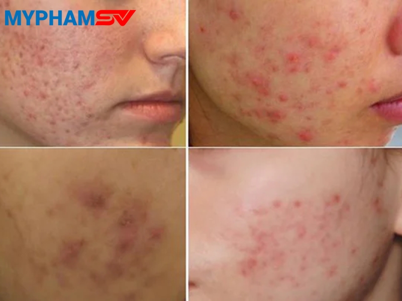 Bật mí cách phục hồi da sau nặn mụn giúp da nhanh lành, không thâm sẹo