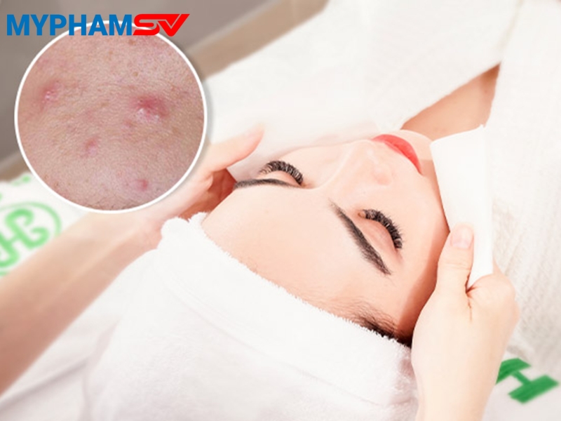 Bật mí cách phục hồi da sau nặn mụn giúp da nhanh lành, không thâm sẹo