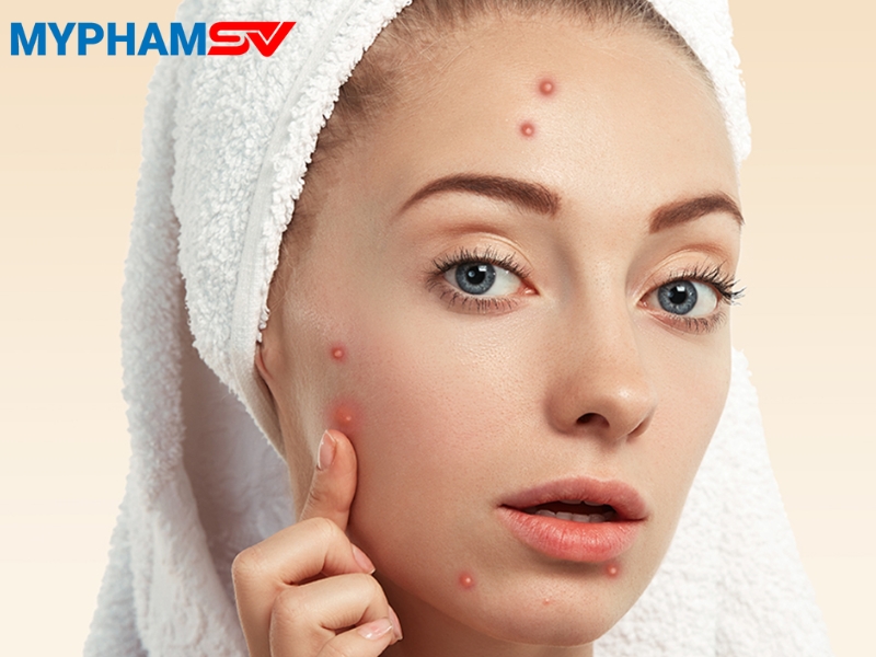 Bật mí cách phục hồi da sau nặn mụn giúp da nhanh lành, không thâm sẹo