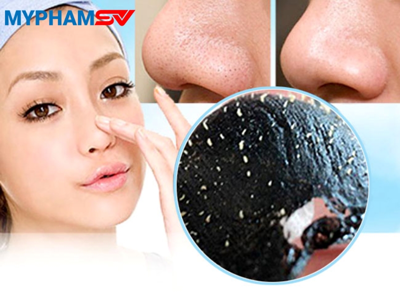 Cách trị mụn đầu đen tại nhà