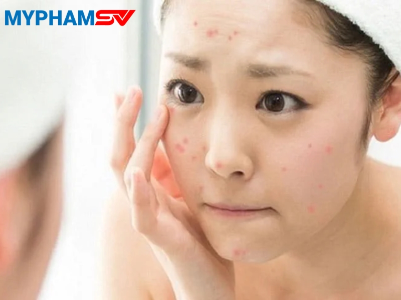Tuổi teen nên chọn gì? Mỹ phẩm nào phù hợp da tuổi dậy thì?
