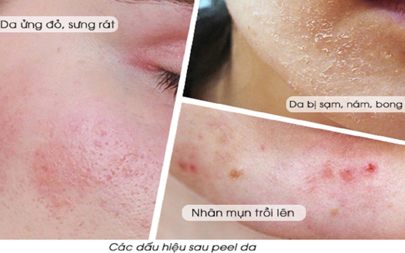 Kem dưỡng phục hồi sau peel da